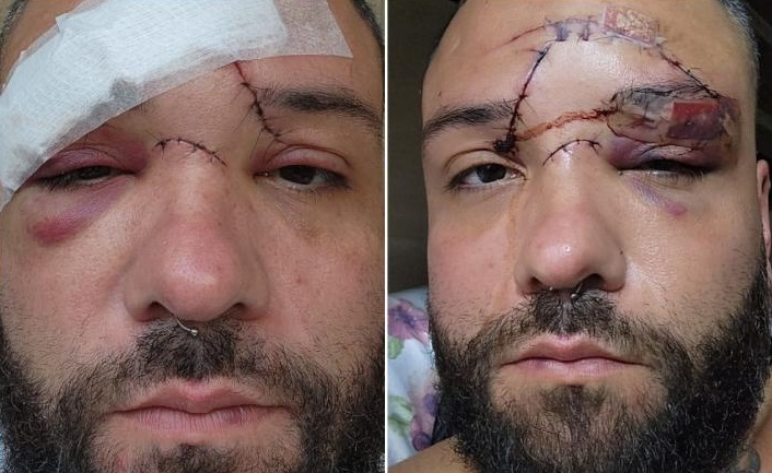 Designer leva 35 pontos no rosto após ataque homofóbico em bar