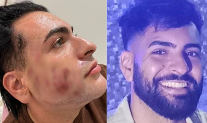 Peeling de fenol: polícia conclui causa da morte de empresário